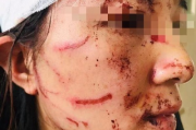 脸上挂彩了？面部受伤究竟咋才算轻伤害？