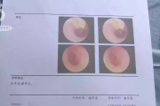 一、耳膜穿孔轻伤，到底有多严重？