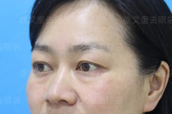 离婚后心碎眼袋多久能消？律师，关键在这几点！