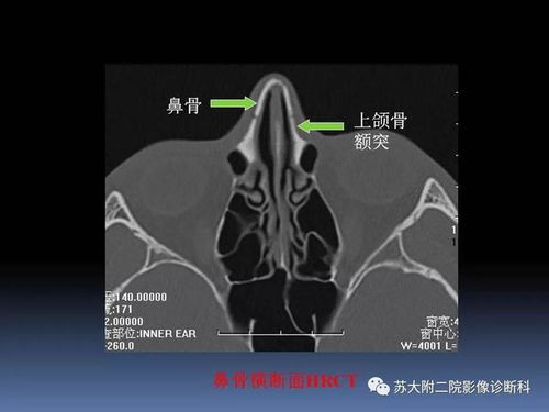 鼻骨骨折算轻伤，打人者会有啥后果？