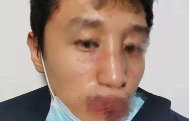 鼻骨骨折轻伤了，对方到底会受到啥惩罚？