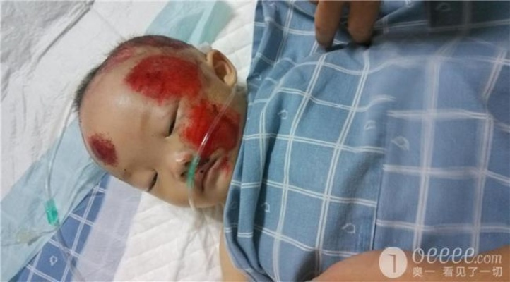 幼儿被车撞成轻伤，家长先别慌！教你这样办