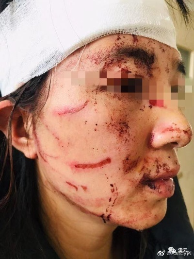 脸上挂彩了？面部受伤究竟咋才算轻伤害？