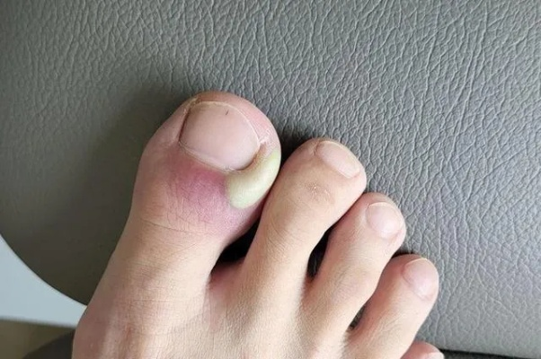 脚小拇指轻伤了，疼又不方便，该咋办？
