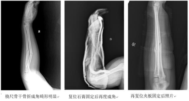 一、别慌！右侧骨折是个大家族，得分情况看！