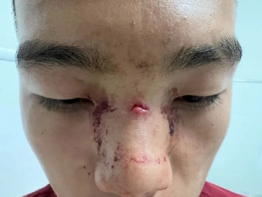 鼻子留疤了？想知道算不算轻伤？鉴定流程看这里！