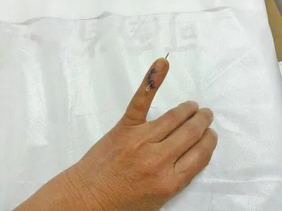 手指骨折了，咋区分是不是轻伤？又算几级伤呢？