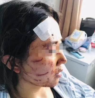 脸上挂彩了？别急，先弄明白啥是轻伤！