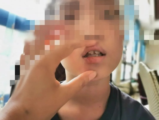 门牙撞掉了？轻伤！赔偿该咋算？律师手把手教你理清头绪