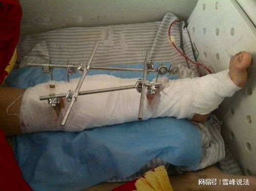 被打成骨折，咋才算轻伤？对案子影响大吗？