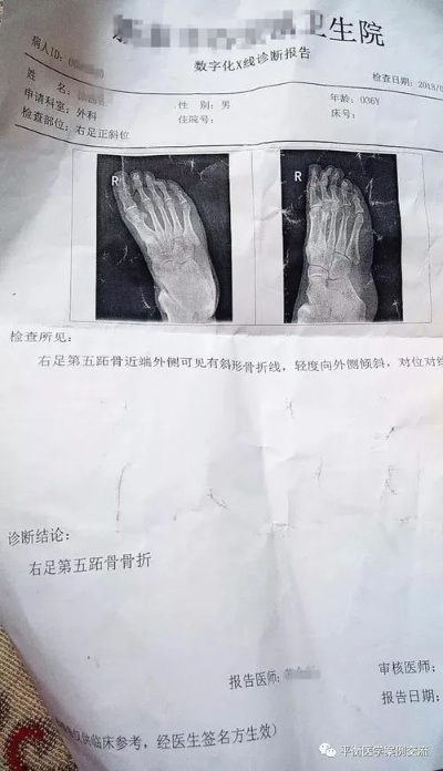 脚背骨折了，算不算轻伤？能评上吗？