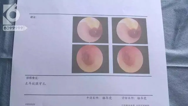 一、耳膜穿孔轻伤，到底有多严重？