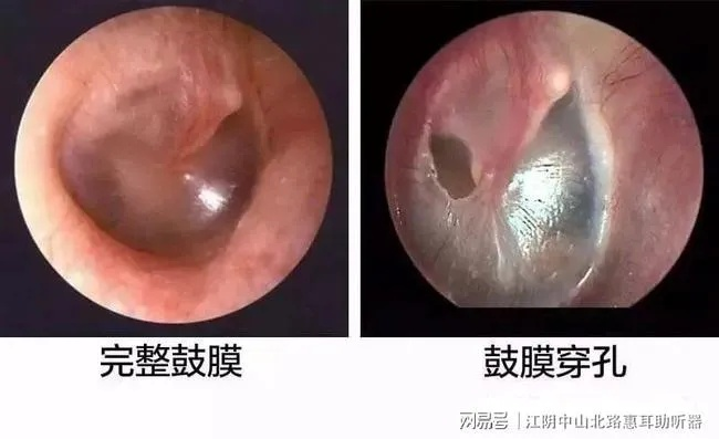 耳膜穿孔了，算轻伤吗？法律上怎么定？