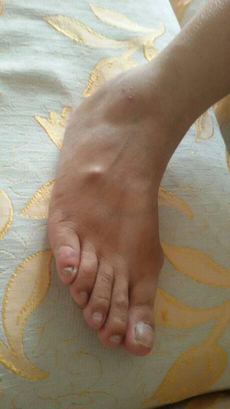 脚骨轻伤怎么治好？不小心加重了怎么办？