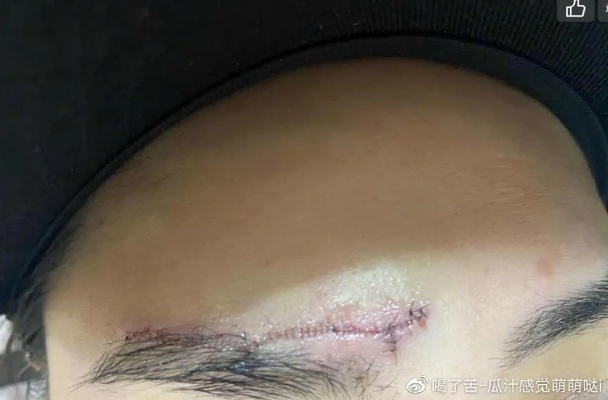 眉骨磕了碰了咋算轻伤？真要是轻伤了该咋办？