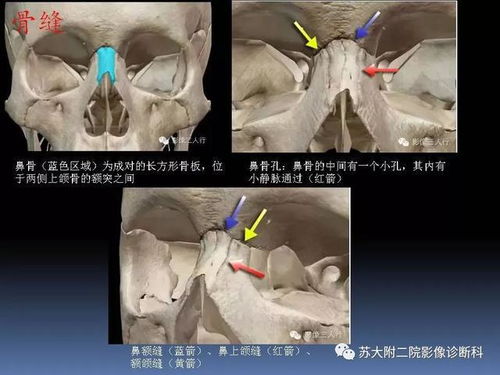鼻子怎么骨折才算轻伤？真骨折了该咋办？