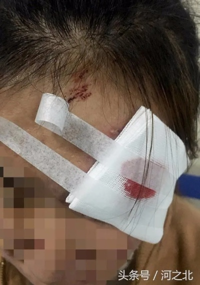 头部受伤了，咋算轻伤？万一真轻伤了，后续咋办？