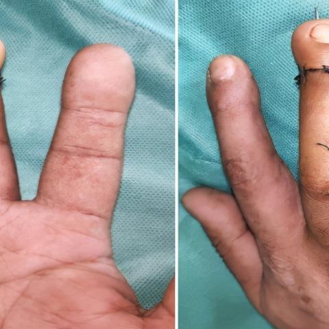 九级工伤能赔多少钱?钱从哪儿来?怎么拿? 九级工伤能赔多少钱?钱从哪儿来?怎么拿?