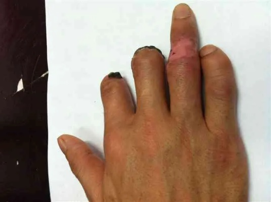 手指工伤了该怎么办?赔偿款拿不到或者给少了又该如何应对? 手指工伤了该怎么办?赔偿款拿不到或者给少了又该如何应对?