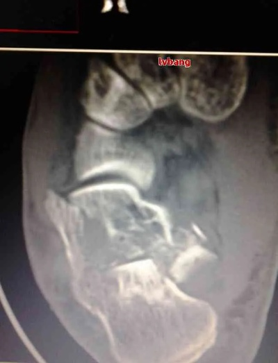 脚脖子的距骨骨折了，工伤能评上几级？后续该咋办？