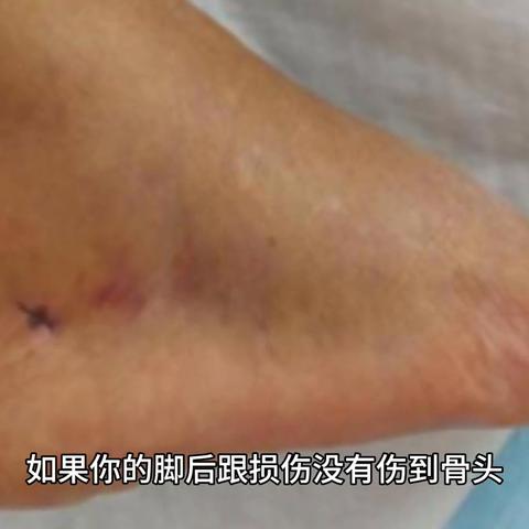 肌腱断裂算几级工伤?工伤认定赔偿该怎么办? 肌腱断裂算几级工伤?工伤认定赔偿该怎么办?