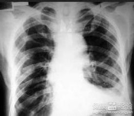 肋骨骨折2根算几级工伤？能赔多少钱？