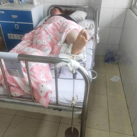 一、手指骨折了，到底算不算工伤？