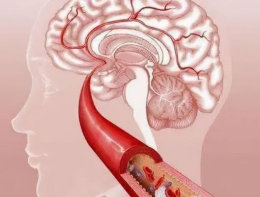 脑梗算工伤吗？别急，律师教你这么看！