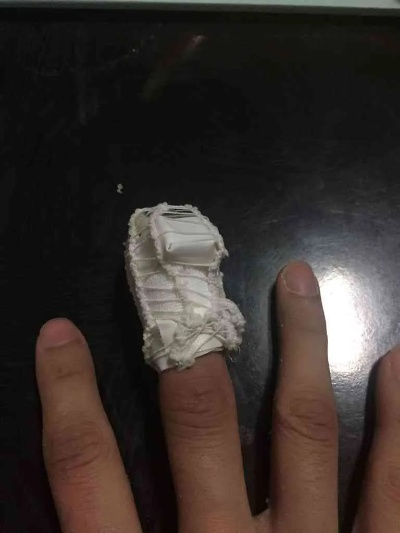 小指骨折了算工伤吗?能评上几级伤残? 小指骨折了算工伤吗?能评上几级伤残?